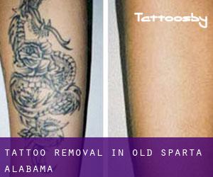 Tattoo Removal in Old Sparta (Alabama)