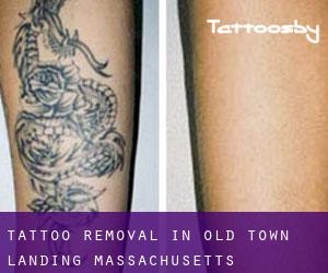 Tattoo Removal in Old Town Landing (Massachusetts)