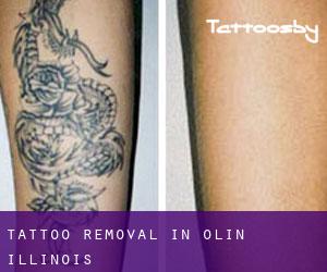 Tattoo Removal in Olin (Illinois)