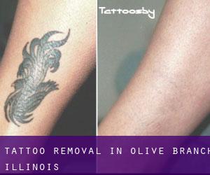 Tattoo Removal in Olive Branch (Illinois)