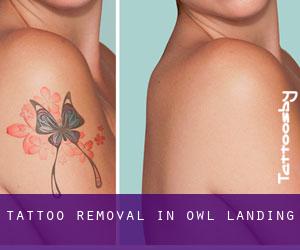 Tattoo Removal in Owl Landing