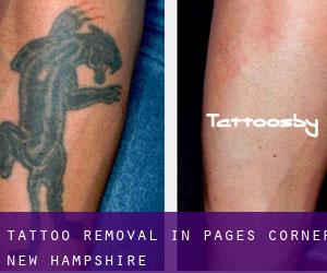 Tattoo Removal in Pages Corner (New Hampshire)