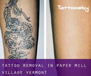 Tattoo Removal in Paper Mill Village (Vermont)