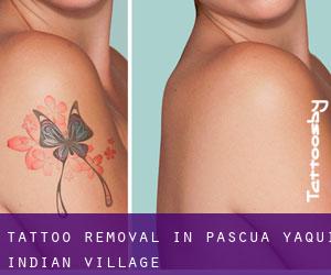 Tattoo Removal in Pascua Yaqui Indian Village