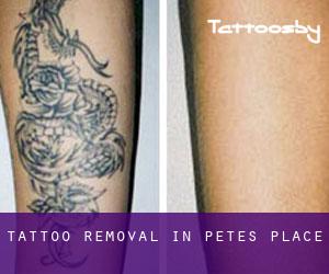 Tattoo Removal in Petes Place