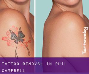 Tattoo Removal in Phil Campbell