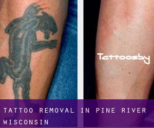 Tattoo Removal in Pine River (Wisconsin)