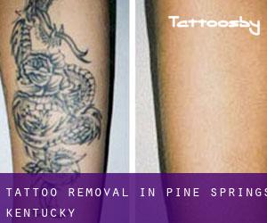 Tattoo Removal in Pine Springs (Kentucky)