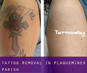 Tattoo Removal in Plaquemines Parish