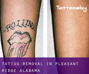 Tattoo Removal in Pleasant Ridge (Alabama)