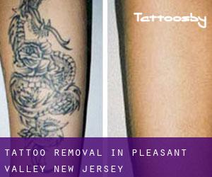 Tattoo Removal in Pleasant Valley (New Jersey)