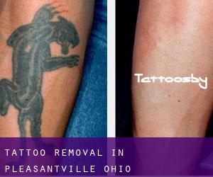 Tattoo Removal in Pleasantville (Ohio)