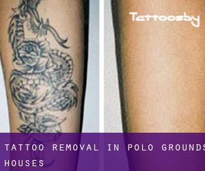 Tattoo Removal in Polo Grounds Houses