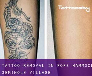 Tattoo Removal in Pops Hammock Seminole Village