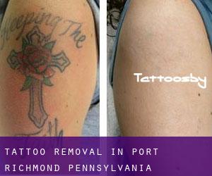 Tattoo Removal in Port Richmond (Pennsylvania)