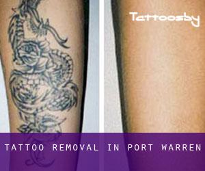 Tattoo Removal in Port Warren