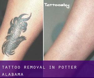 Tattoo Removal in Potter (Alabama)