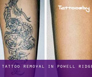 Tattoo Removal in Powell Ridge