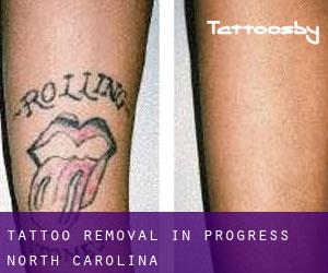 Tattoo Removal in Progress (North Carolina)