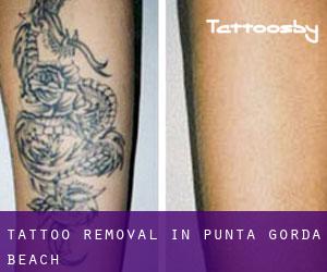 Tattoo Removal in Punta Gorda Beach