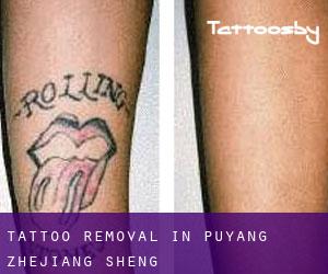 Tattoo Removal in Puyang (Zhejiang Sheng)