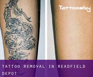 Tattoo Removal in Readfield Depot