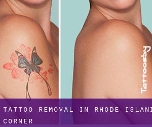 Tattoo Removal in Rhode Island Corner