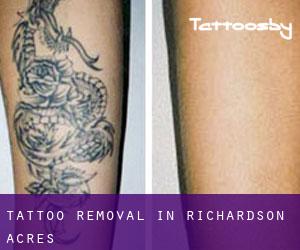 Tattoo Removal in Richardson Acres