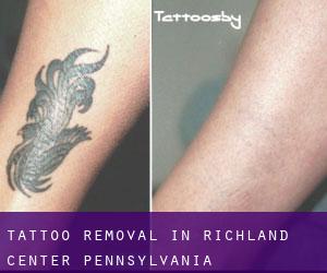 Tattoo Removal in Richland Center (Pennsylvania)