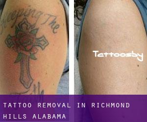 Tattoo Removal in Richmond Hills (Alabama)