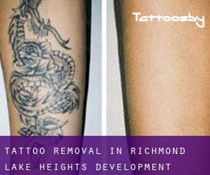 Tattoo Removal in Richmond Lake Heights Development
