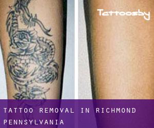 Tattoo Removal in Richmond (Pennsylvania)