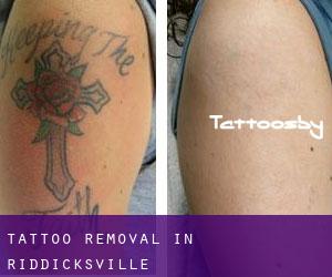 Tattoo Removal in Riddicksville