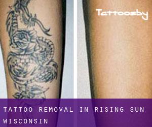 Tattoo Removal in Rising Sun (Wisconsin)