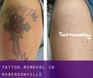 Tattoo Removal in Robersonville