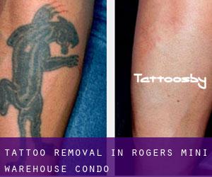 Tattoo Removal in Rogers Mini Warehouse Condo