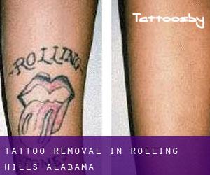 Tattoo Removal in Rolling Hills (Alabama)