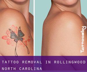 Tattoo Removal in Rollingwood (North Carolina)