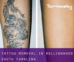 Tattoo Removal in Rollingwood (South Carolina)
