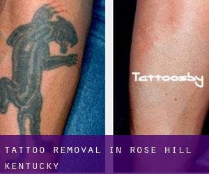 Tattoo Removal in Rose Hill (Kentucky)
