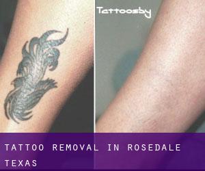 Tattoo Removal in Rosedale (Texas)