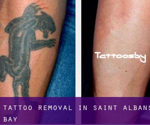 Tattoo Removal in Saint Albans Bay