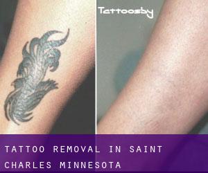 Tattoo Removal in Saint Charles (Minnesota)