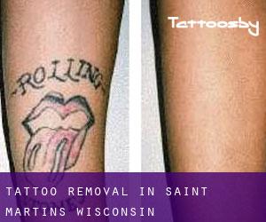 Tattoo Removal in Saint Martins (Wisconsin)