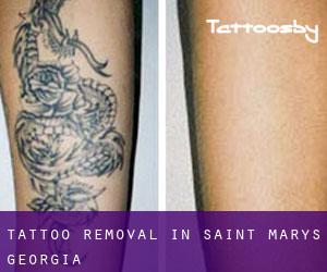 Tattoo Removal in Saint Marys (Georgia)