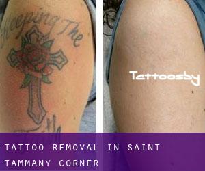Tattoo Removal in Saint Tammany Corner