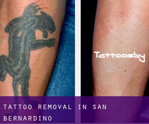 Tattoo Removal in San Bernardino
