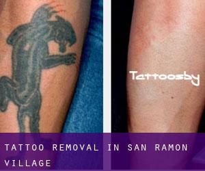 Tattoo Removal in San Ramon Village