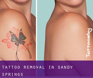 Tattoo Removal in Sandy Springs