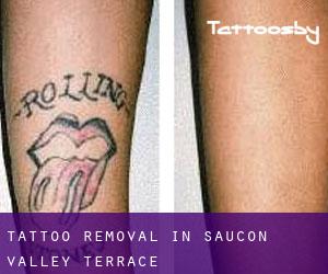 Tattoo Removal in Saucon Valley Terrace